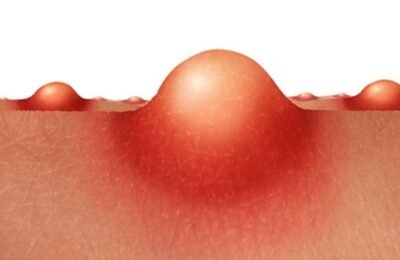 Understand vaginal acne causes, prevention and treatment options explained by expert