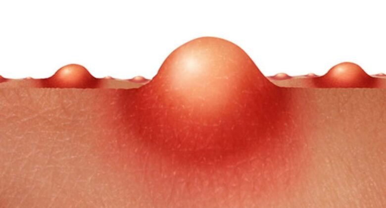 Understand vaginal acne causes, prevention and treatment options explained by expert